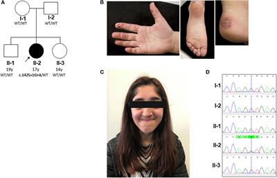 Secondary C1q Deficiency in Activated PI3Kδ Syndrome Type 2